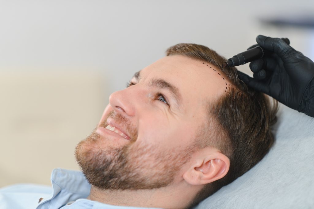 Doctor marking young man's forehead with hair loss problem